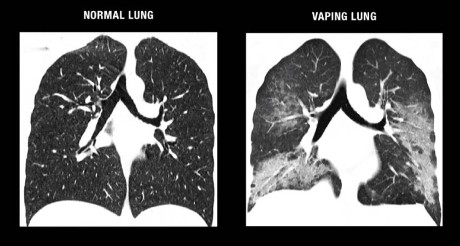Normal Lung vs Vaping Lung image